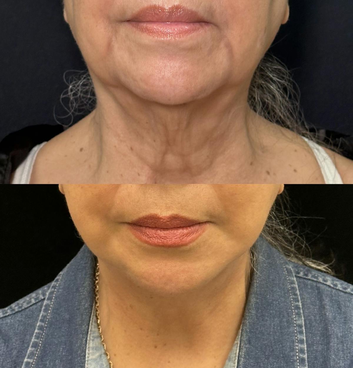 Necklift Before & After Gallery - Patient 242410 - Image 3