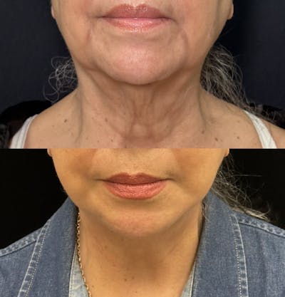 Deep Plane Facelift Before & After Gallery - Patient 209678 - Image 3