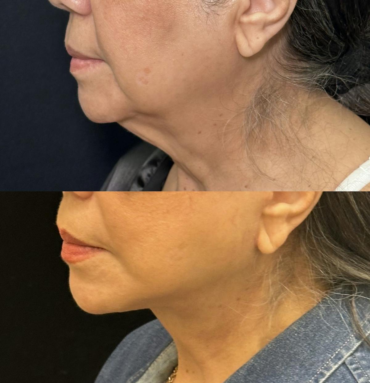 Necklift Before & After Gallery - Patient 242410 - Image 5