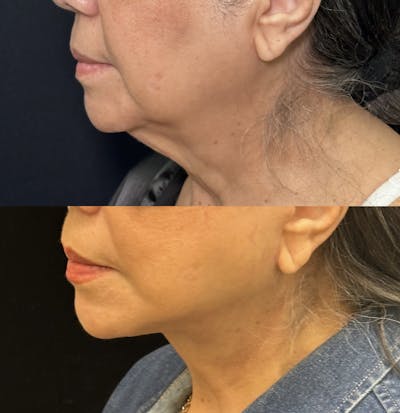 Deep Plane Facelift Before & After Gallery - Patient 209678 - Image 5