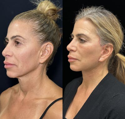 Necklift Before & After Gallery - Patient 226350 - Image 4