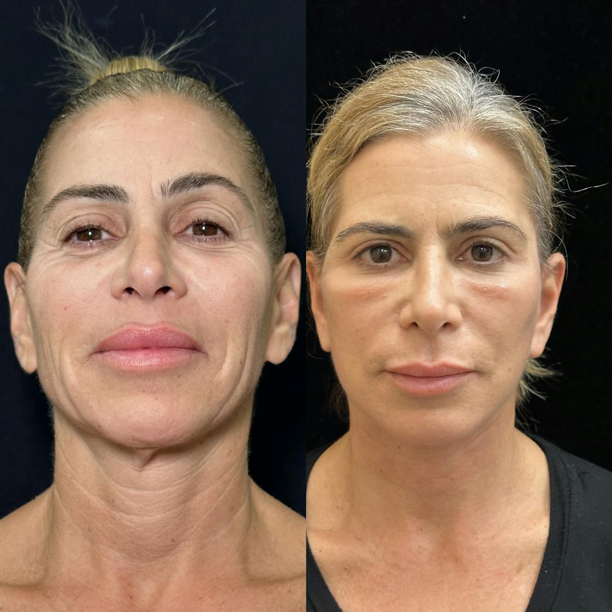 Necklift Before & After Gallery - Patient 226350 - Image 3