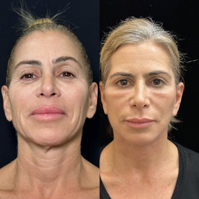 Necklift Before & After Gallery - Patient 226350 - Image 3