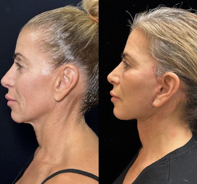 Necklift Before & After Gallery - Patient 226350 - Image 5