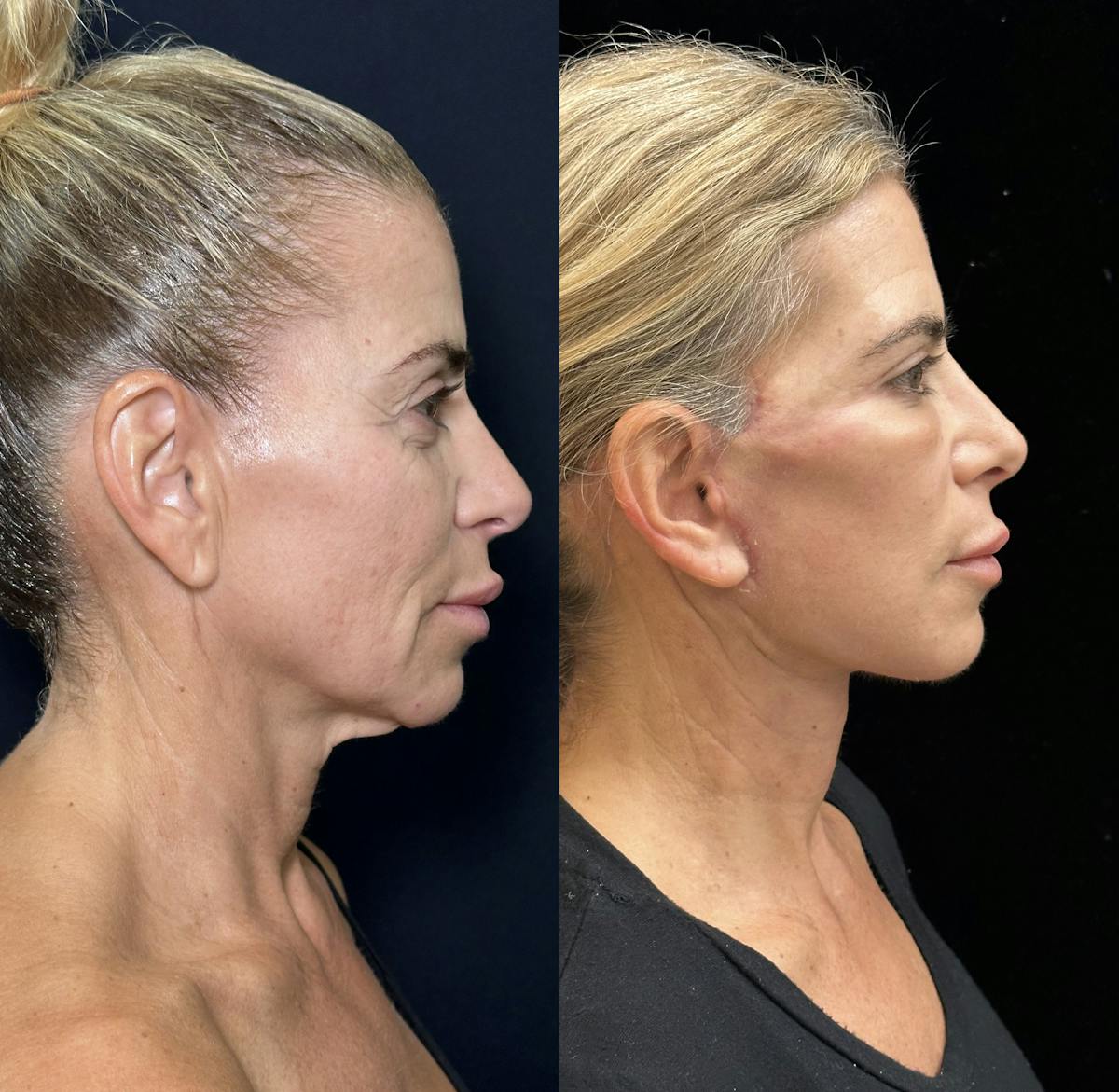 Necklift Before & After Gallery - Patient 226350 - Image 1