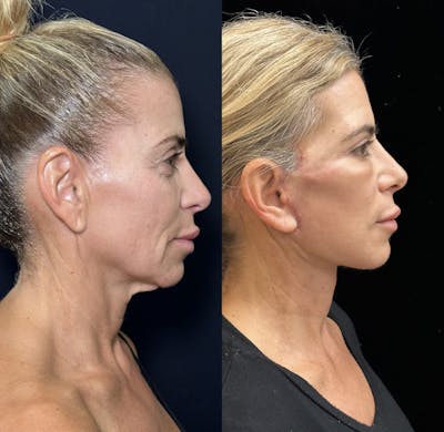 Facial Fat Transfer Before & After Gallery - Patient 391871 - Image 1