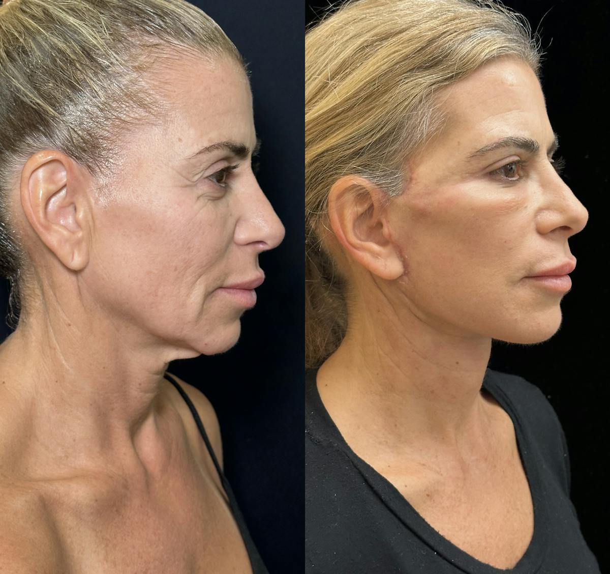 Necklift Before & After Gallery - Patient 226350 - Image 2
