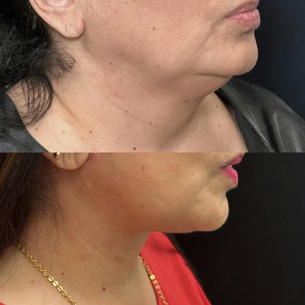 Necklift Before & After Gallery - Patient 424393 - Image 2