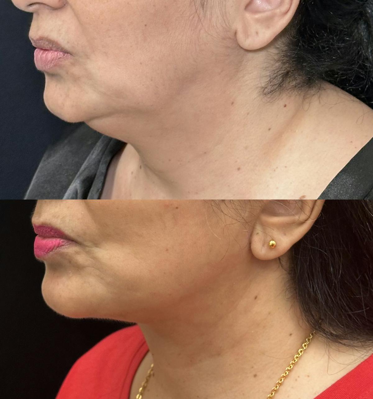 Necklift Before & After Gallery - Patient 424393 - Image 3
