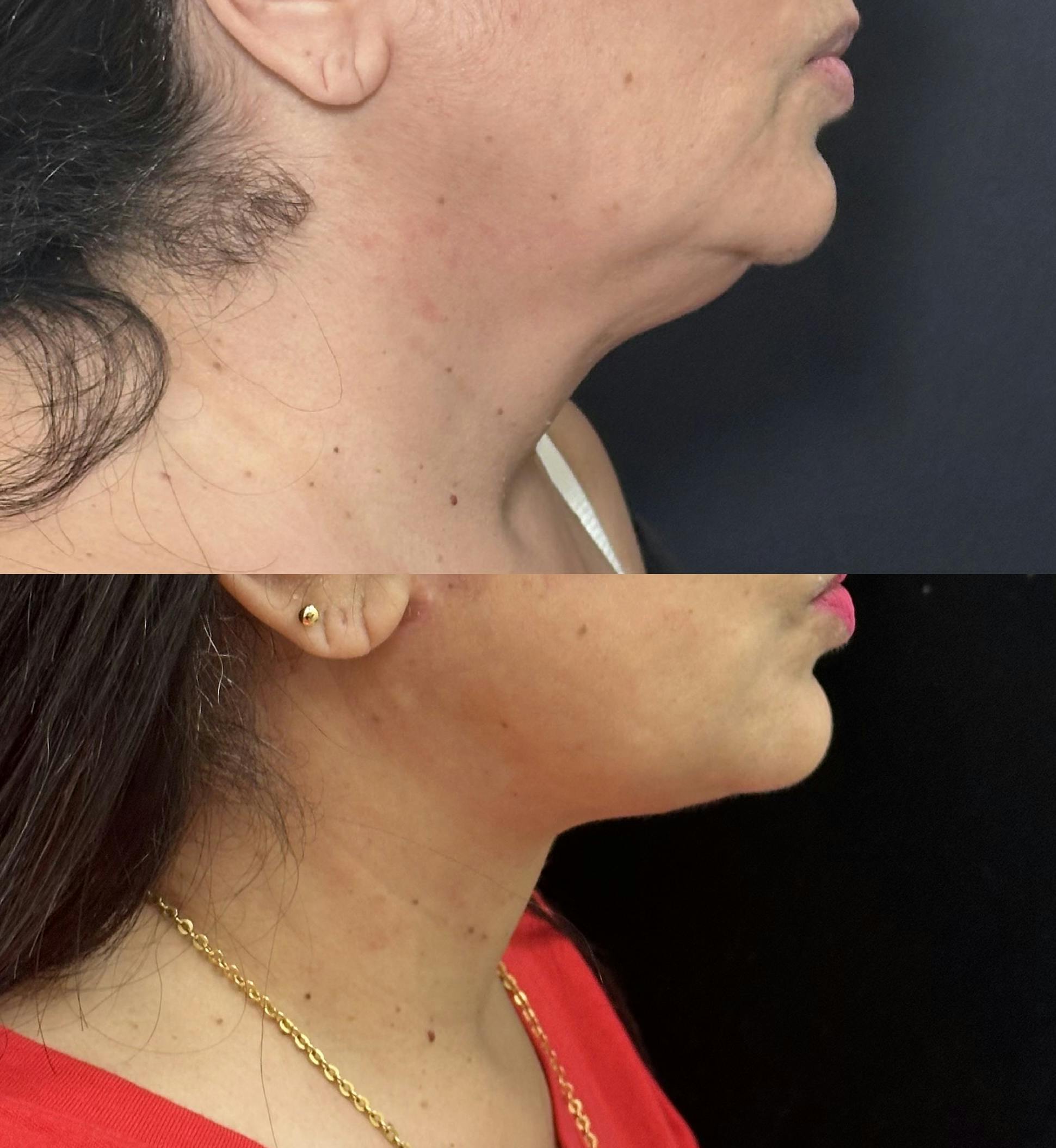 Deep Plane Facelift Before & After Gallery - Patient 368178 - Image 1