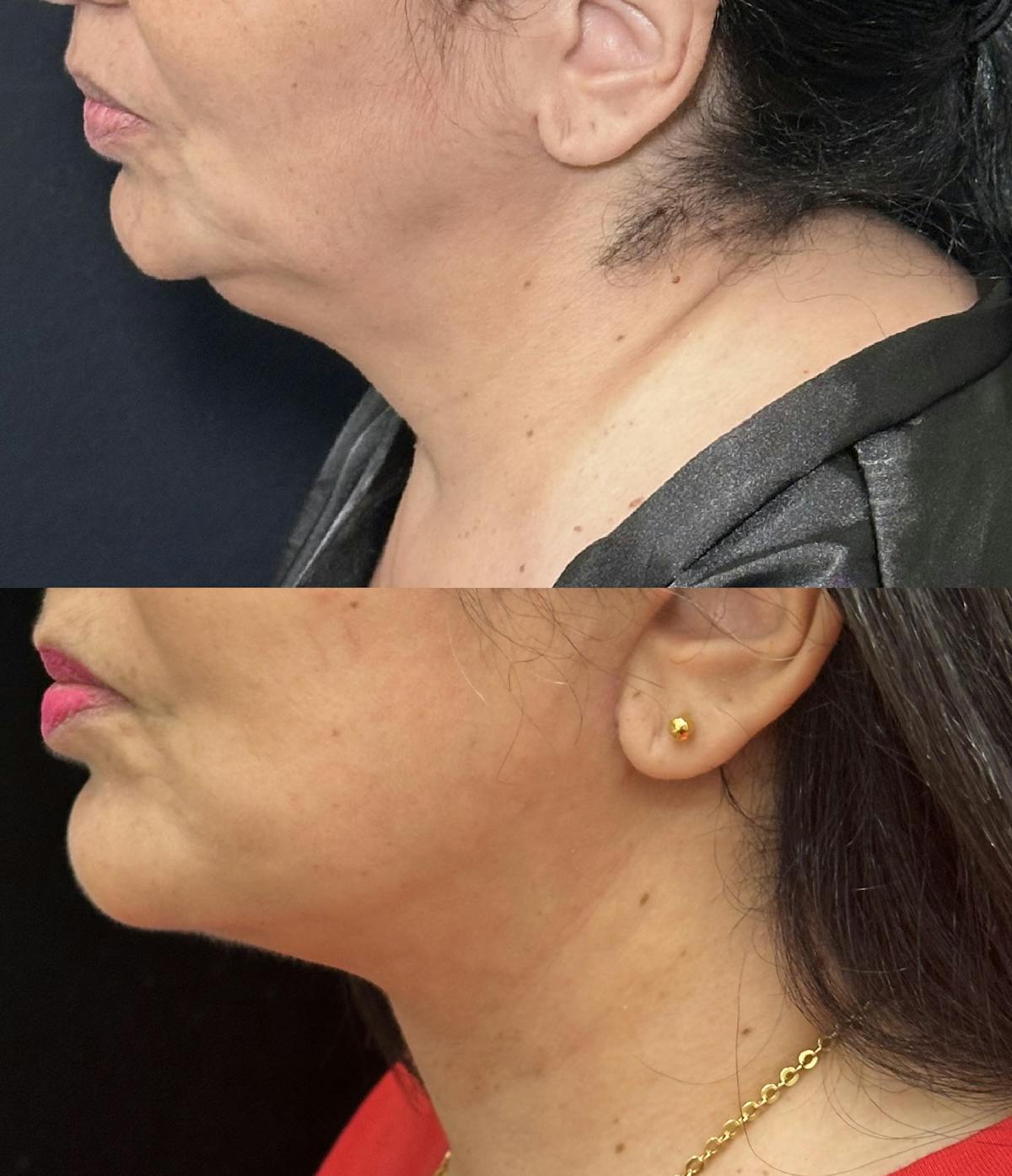 Necklift Before & After Gallery - Patient 424393 - Image 4