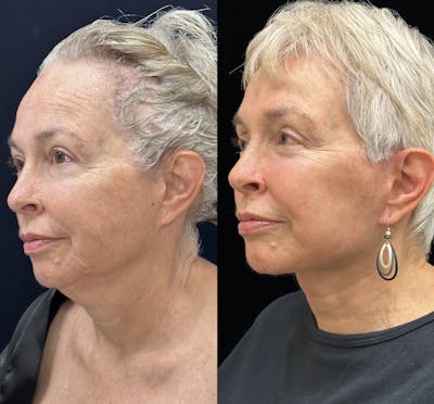 Necklift Before & After Gallery - Patient 301102 - Image 3
