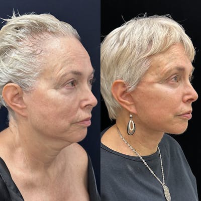 Necklift Before & After Gallery - Patient 301102 - Image 2