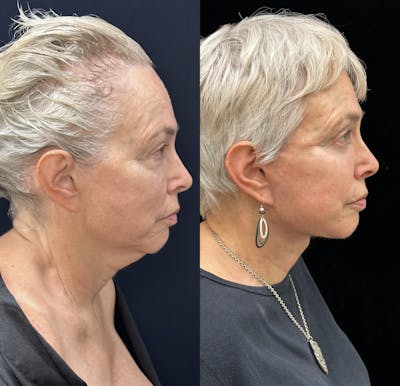 Necklift Before & After Gallery - Patient 301102 - Image 1