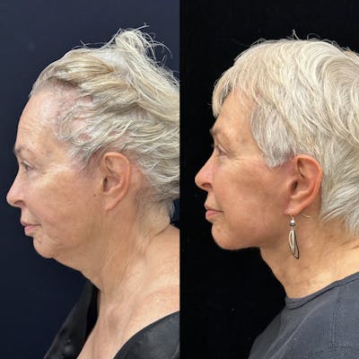 Necklift Before & After Gallery - Patient 301102 - Image 4
