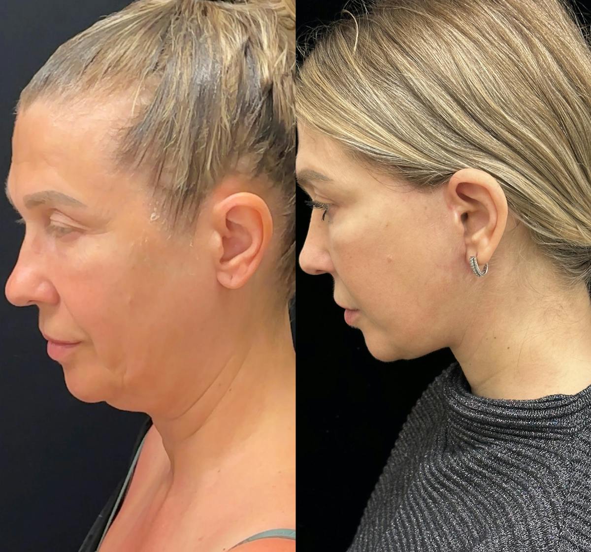 Necklift Before & After Gallery - Patient 160705 - Image 5