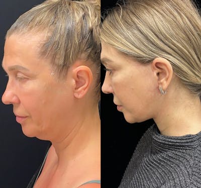 Deep Plane Facelift Before & After Gallery - Patient 135096 - Image 5