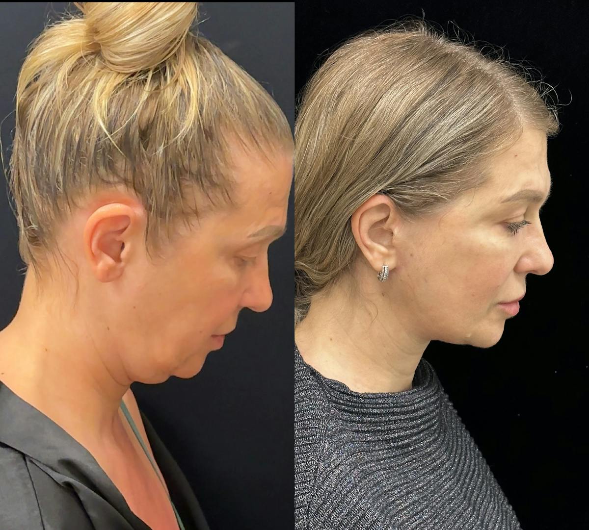 Necklift Before & After Gallery - Patient 160705 - Image 4