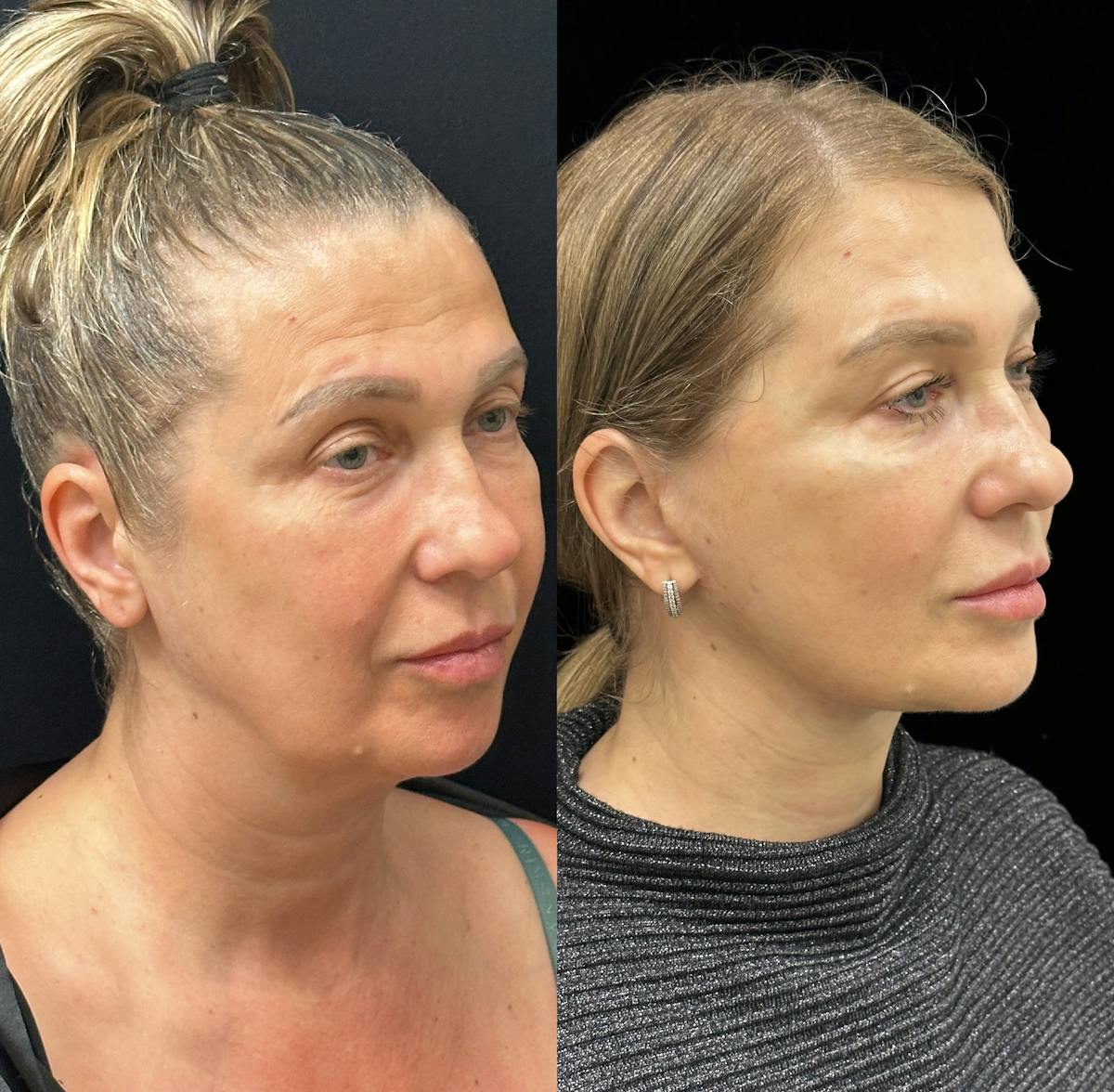 Necklift Before & After Gallery - Patient 160705 - Image 2