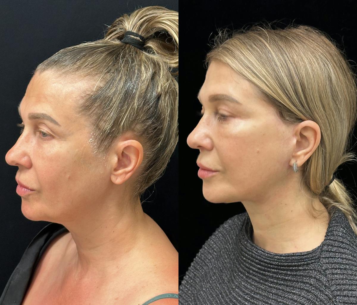 Necklift Before & After Gallery - Patient 160705 - Image 6