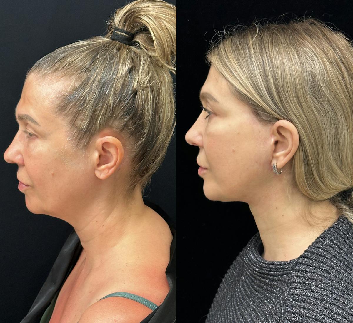 Necklift Before & After Gallery - Patient 160705 - Image 7