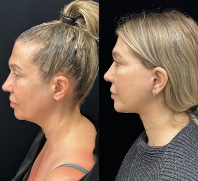 Deep Plane Facelift Before & After Gallery - Patient 135096 - Image 7