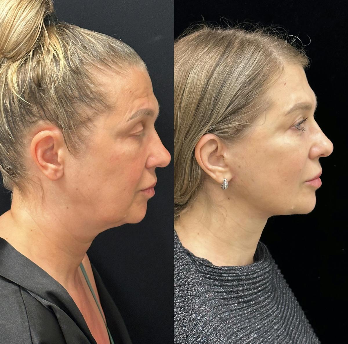Necklift Before & After Gallery - Patient 160705 - Image 1