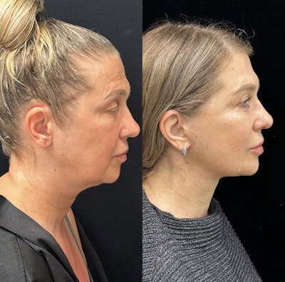 Deep Plane Facelift Before & After Gallery - Patient 135096 - Image 1