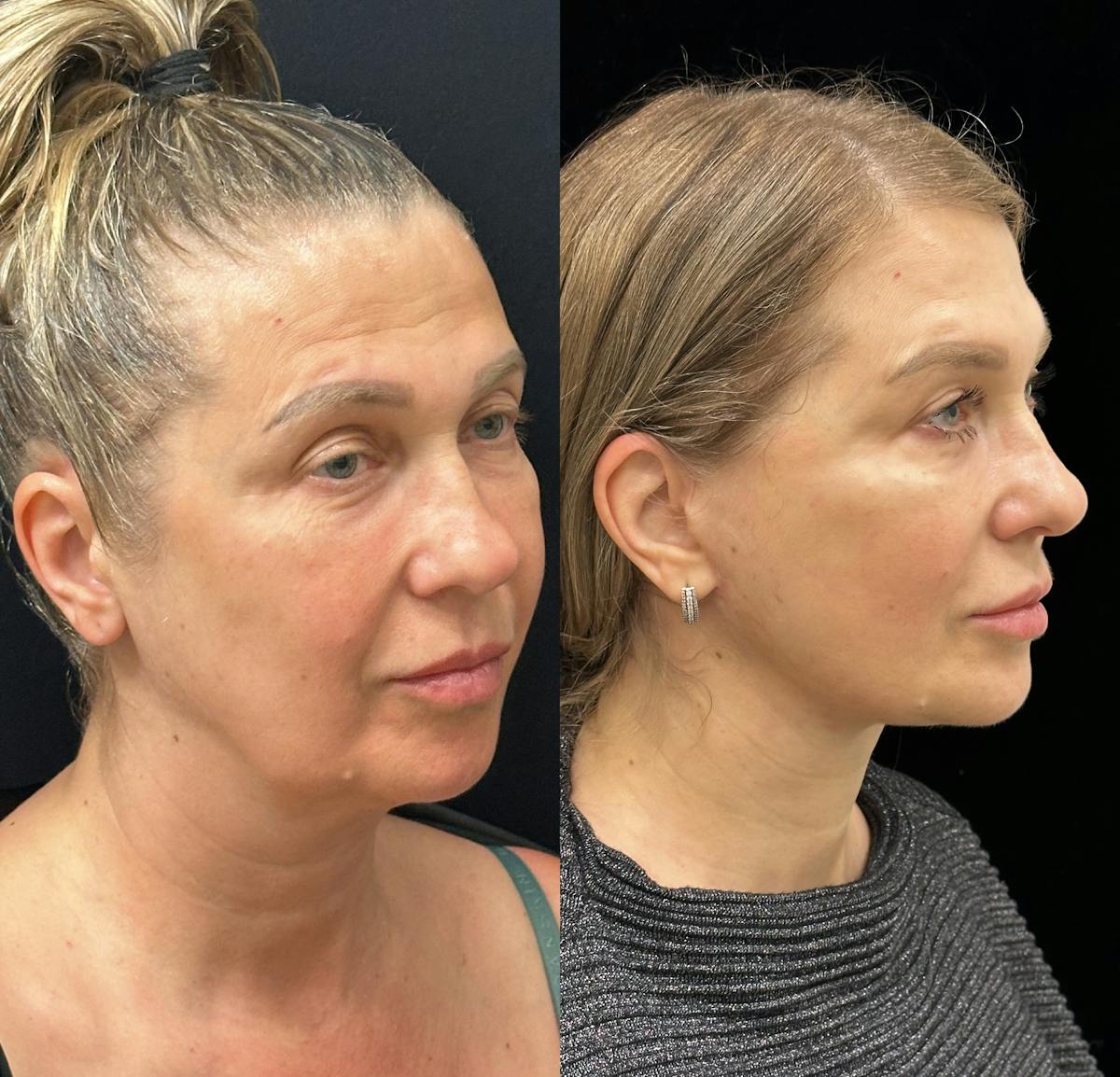 Necklift Before & After Gallery - Patient 160705 - Image 3