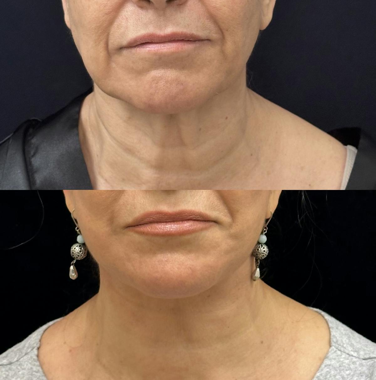 Necklift Before & After Gallery - Patient 259761 - Image 4