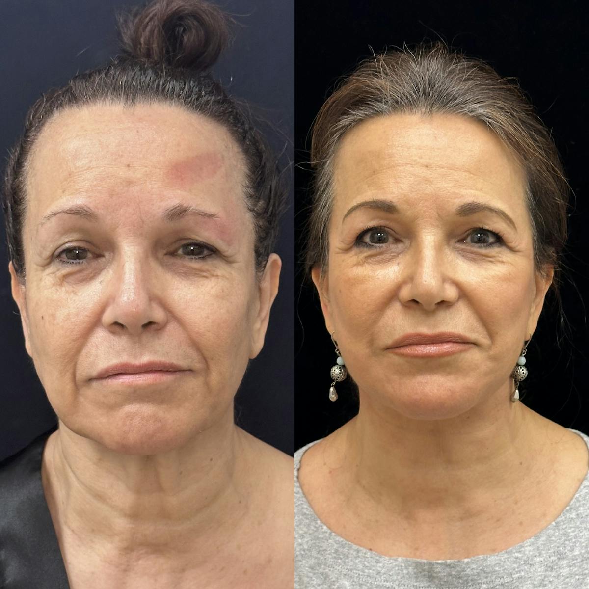 Necklift Before & After Gallery - Patient 259761 - Image 5