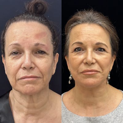 Deep Plane Facelift Before & After Gallery - Patient 135280 - Image 5