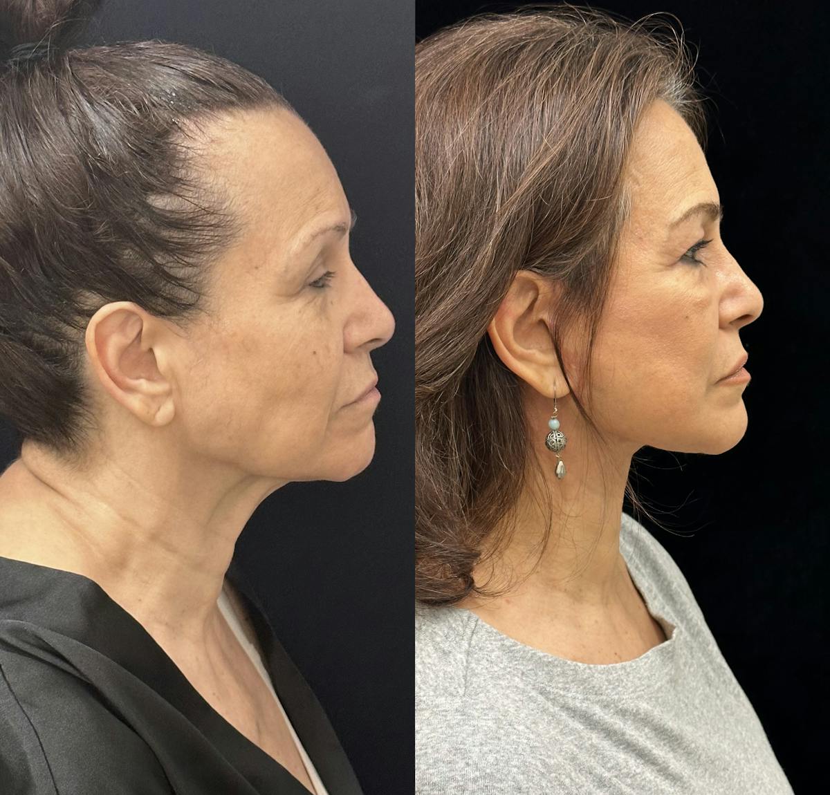Necklift Before & After Gallery - Patient 259761 - Image 1