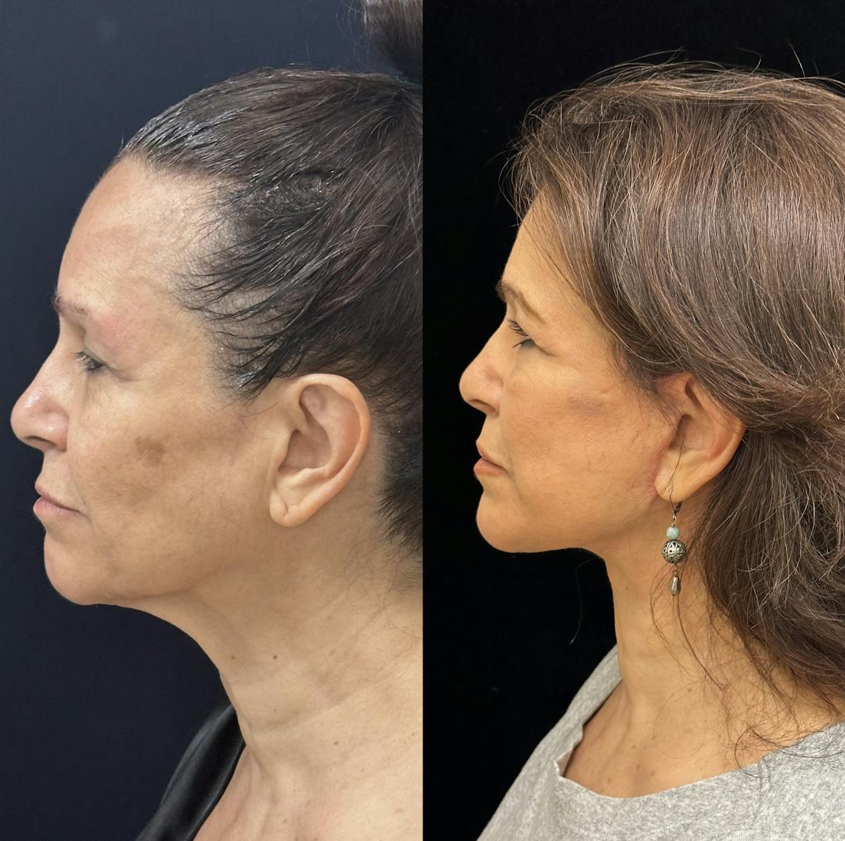 Necklift Before & After Gallery - Patient 259761 - Image 7
