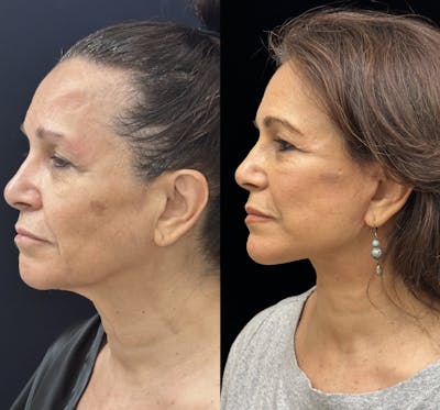 Deep Plane Facelift Before & After Gallery - Patient 135280 - Image 6