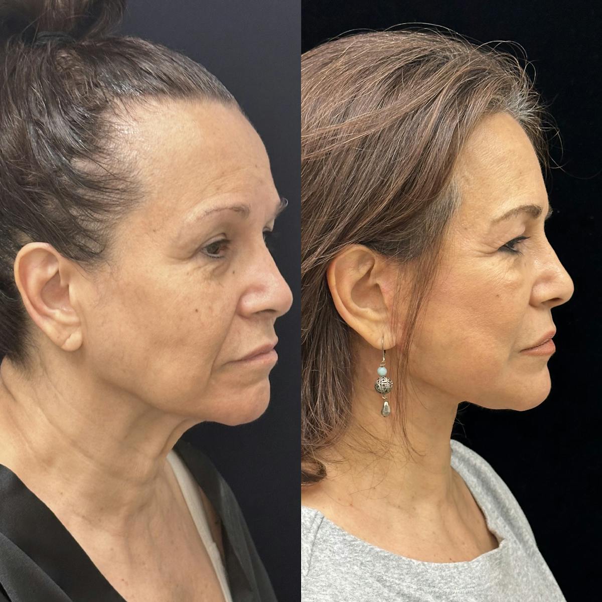 Necklift Before & After Gallery - Patient 259761 - Image 2