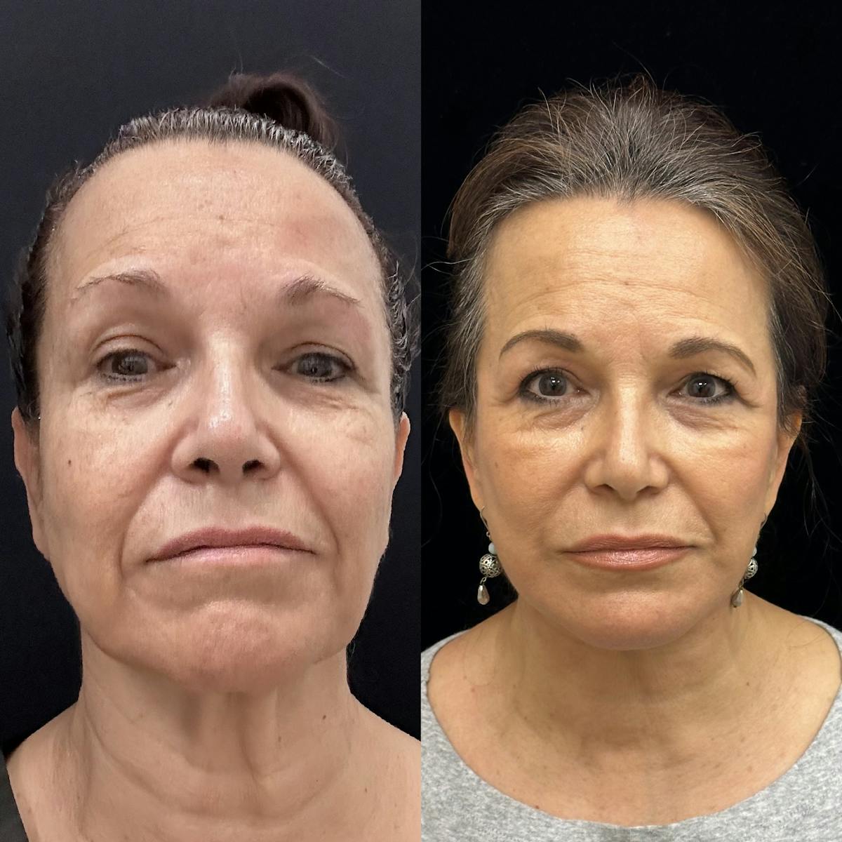 Necklift Before & After Gallery - Patient 259761 - Image 3