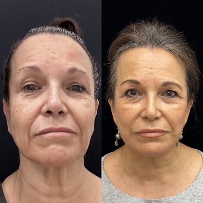 Deep Plane Facelift Before & After Gallery - Patient 135280 - Image 3