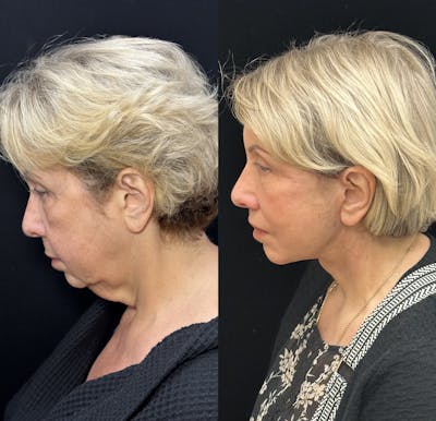 Deep Plane Facelift Before & After Gallery - Patient 193186 - Image 4