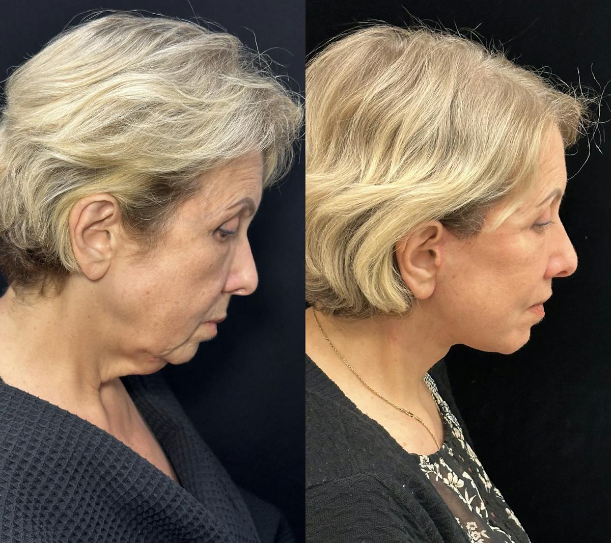 Necklift Before & After Gallery - Patient 253518 - Image 3