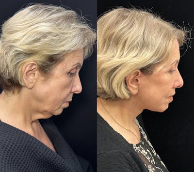 Deep Plane Facelift Before & After Gallery - Patient 193186 - Image 3