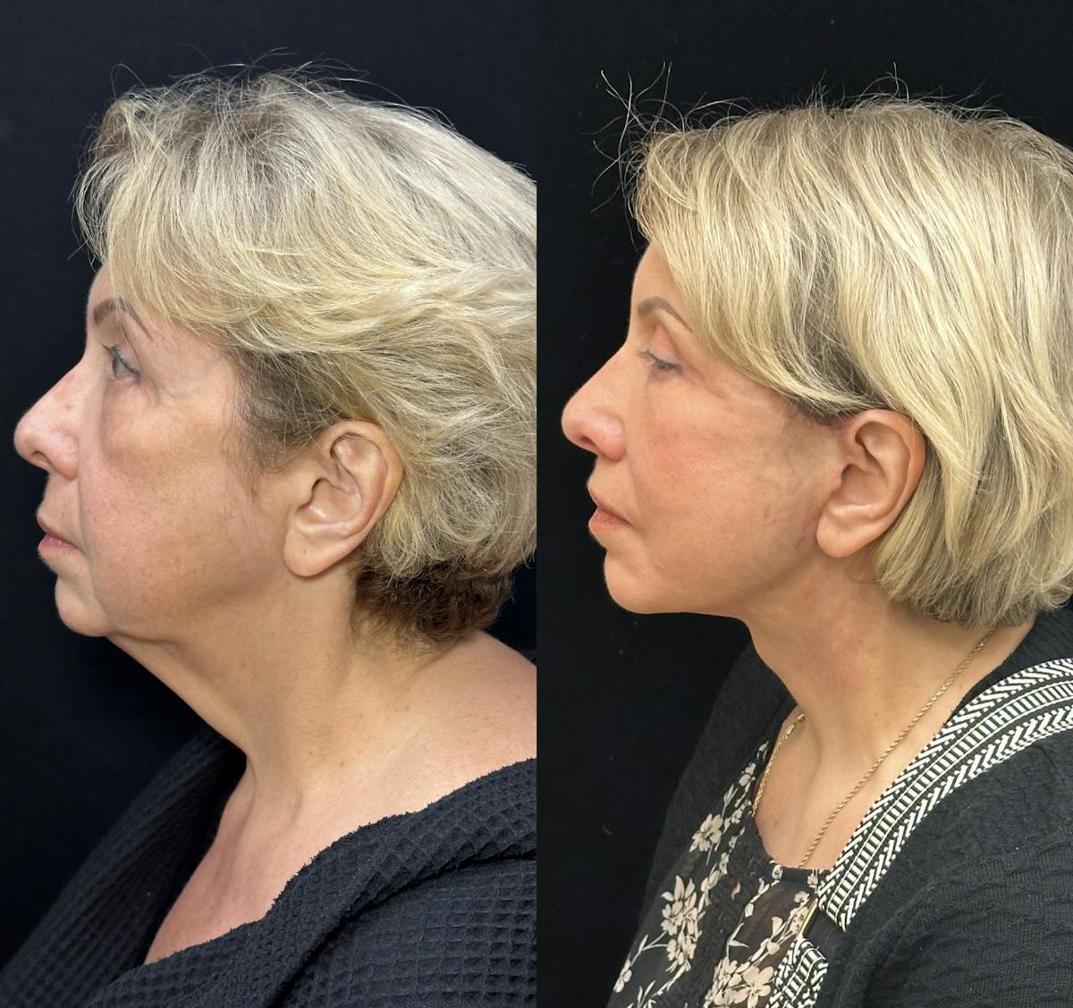 Necklift Before & After Gallery - Patient 253518 - Image 5