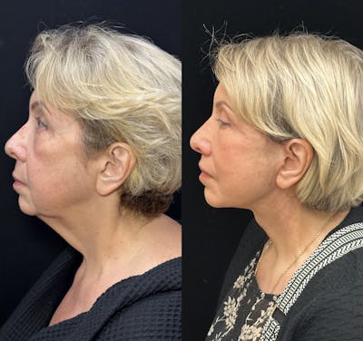 Deep Plane Facelift Before & After Gallery - Patient 193186 - Image 5