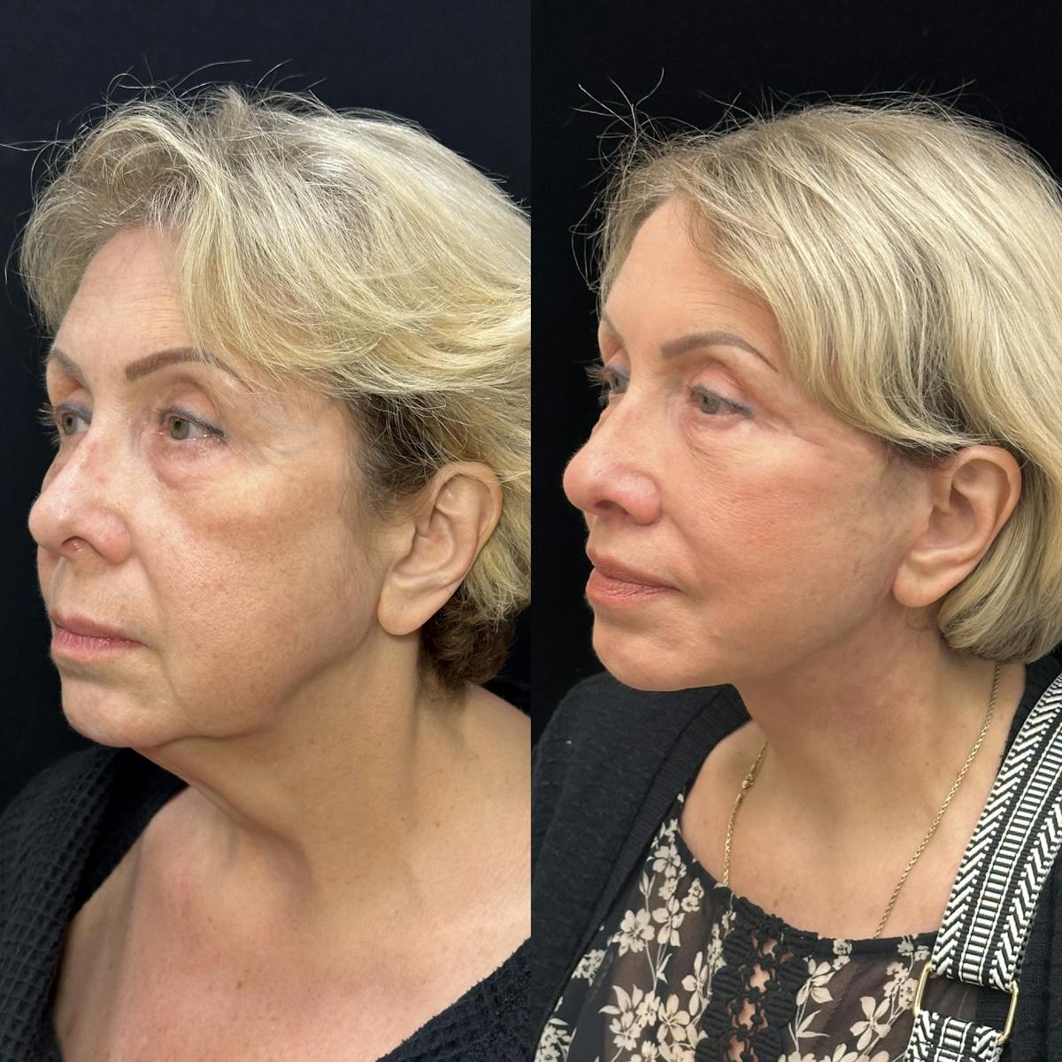 Necklift Before & After Gallery - Patient 253518 - Image 6