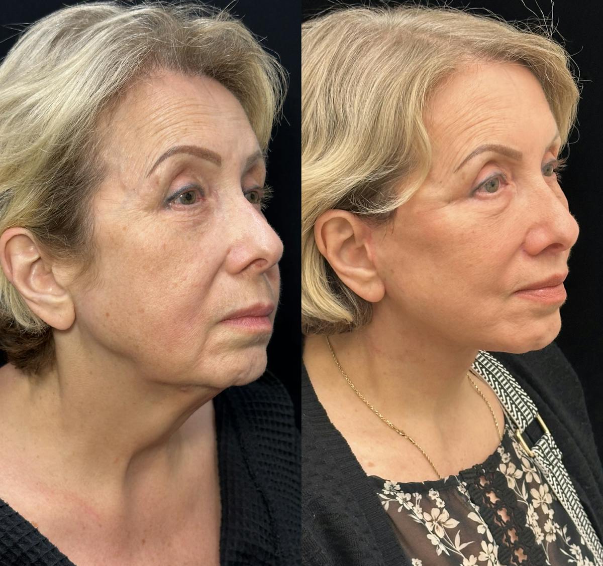 Necklift Before & After Gallery - Patient 253518 - Image 1