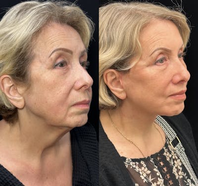 Deep Plane Facelift Before & After Gallery - Patient 193186 - Image 1