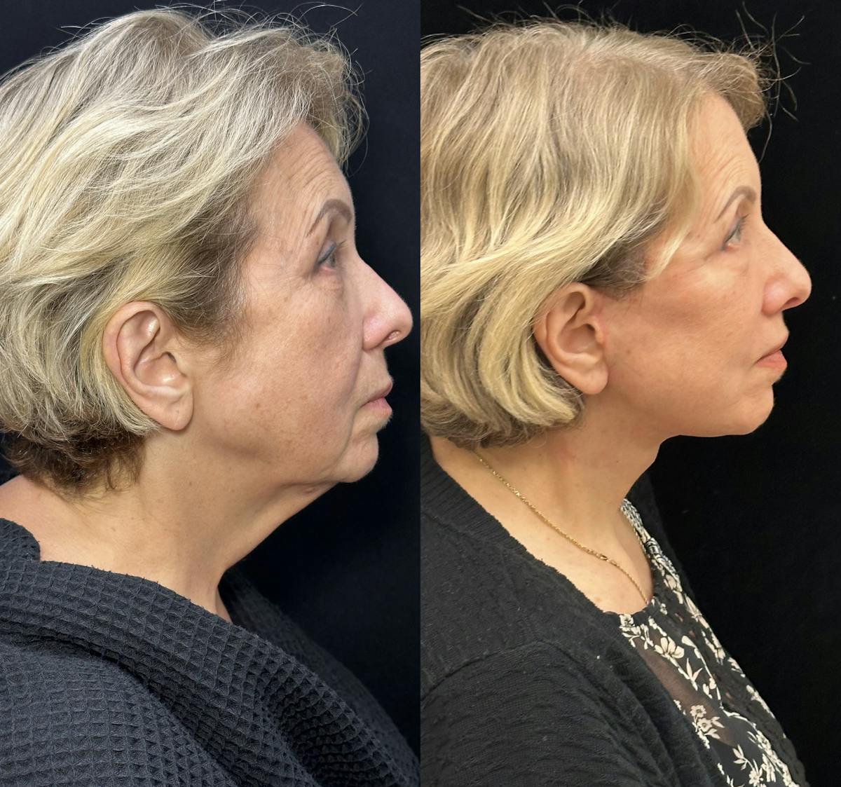Necklift Before & After Gallery - Patient 253518 - Image 2