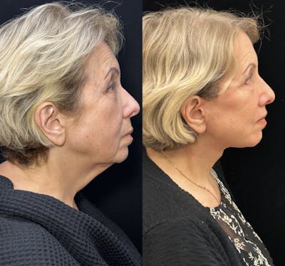 Deep Plane Facelift Before & After Gallery - Patient 193186 - Image 2