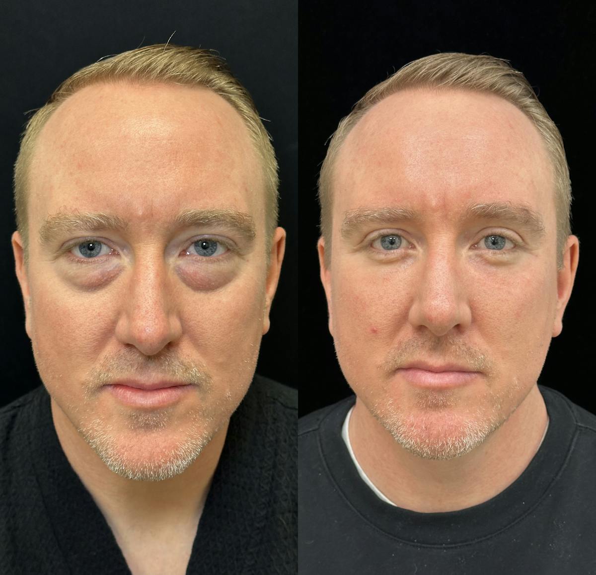 Lower Blepharoplasty Before & After Gallery - Patient 134836 - Image 1