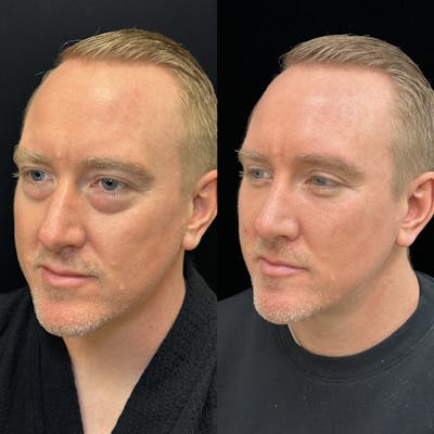 Lower Blepharoplasty Before & After Gallery - Patient 134836 - Image 3